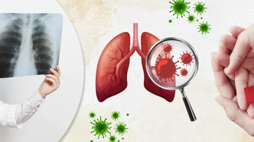 HIV-and-Pneumonia-Prevention-Treatment-and-Navigating-Respiratory-Health